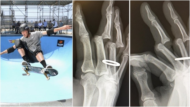 Tony Hawk y las radiografías de sus dedos rotos.