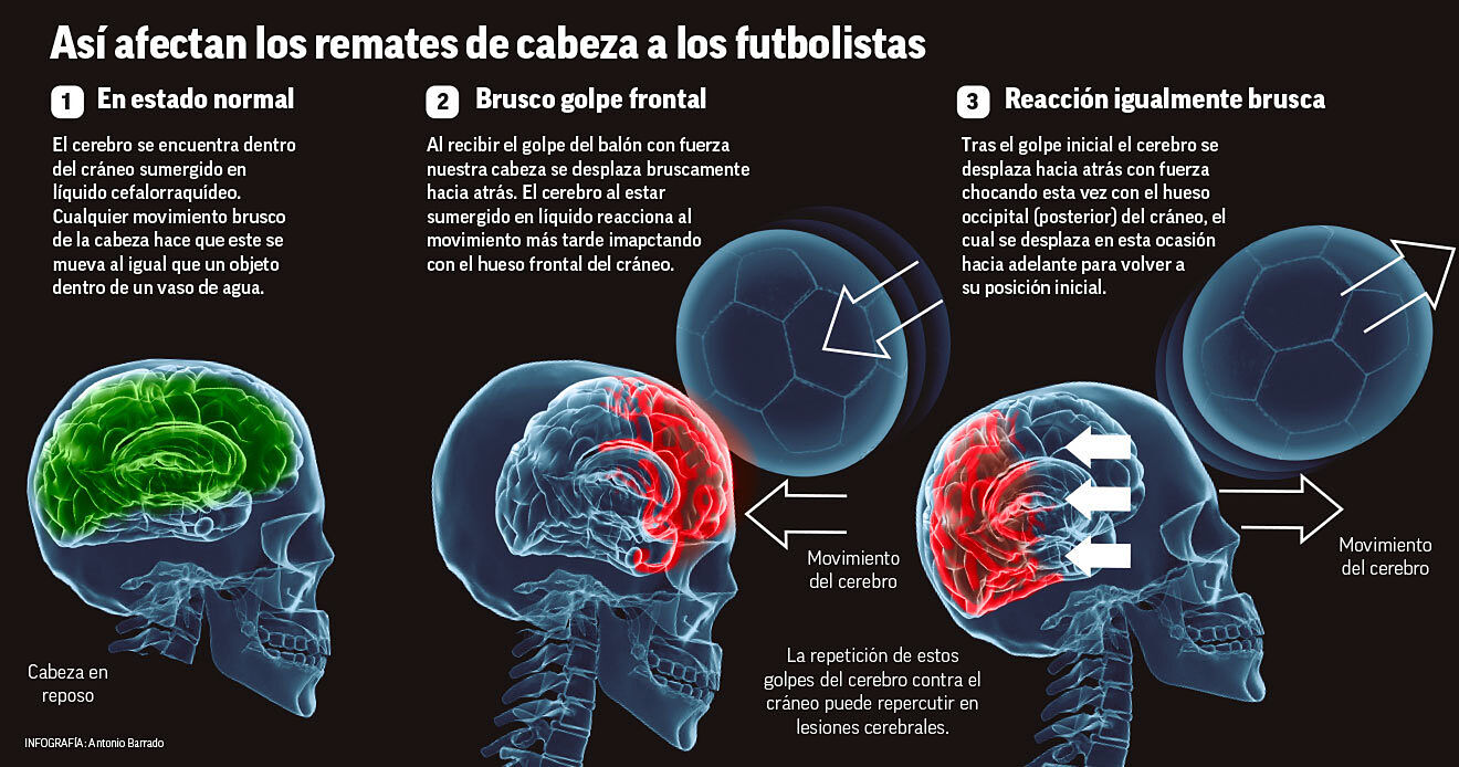 ¿hacia Un Fútbol Sin Remates De Cabeza Debemos Limitarlos Marca