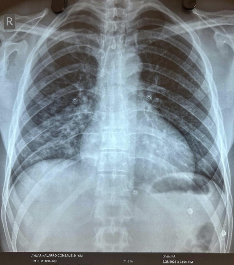 La radiografía de los pulmones de Navarro en la que se refleja el edema que sufría al llegar al hospital.