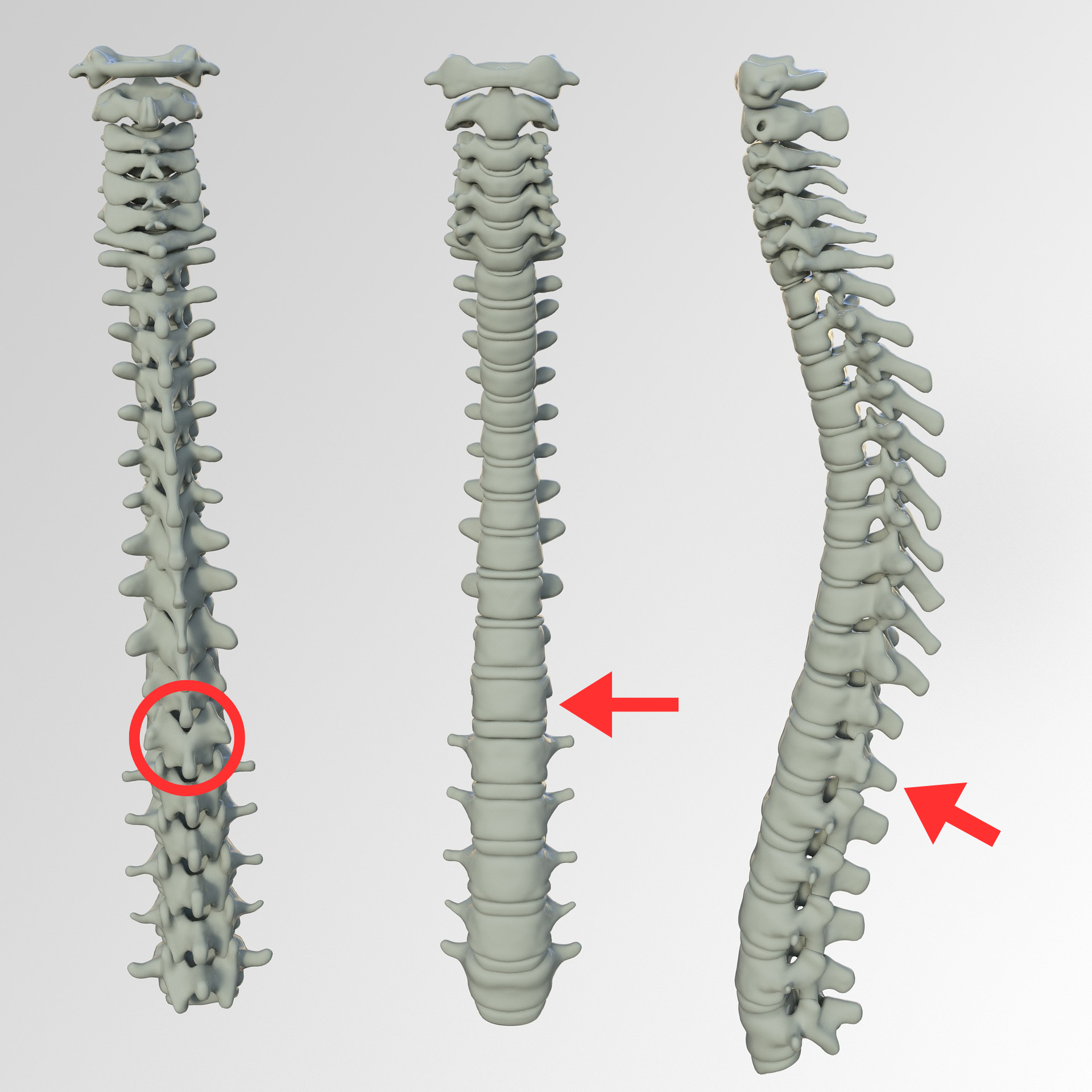 Dorsal 12, la vértebra que se fracturó Andrea.