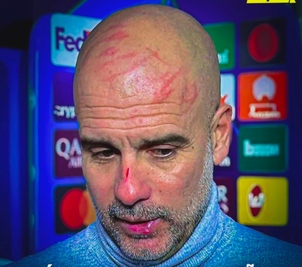 Image of Pep Guardiola with scratches after the Champions League draw with Feyenoord