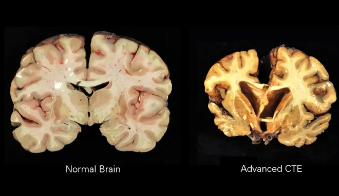 The long controversy of the CTE in the NFL: How do your players affect your head?